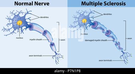 Nerf normal et la sclérose en plaques illustration Illustration de Vecteur