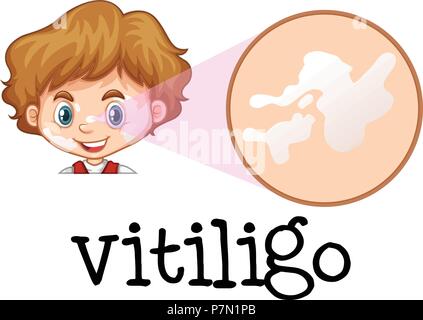 Un garçon avec un Vitiligo sur le visage illustration Illustration de Vecteur