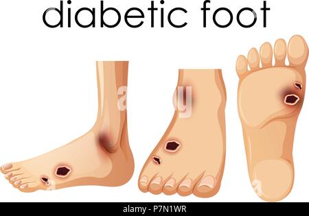 Pied humain et d'une illustration Illustration de Vecteur