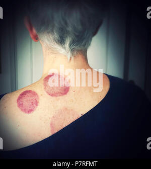 Senior Woman with Cupping Marks sur l'épaule Banque D'Images