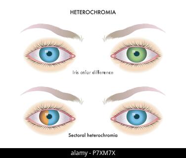 Vector illustration médicale des symptômes de heterochromia de l'iris Illustration de Vecteur