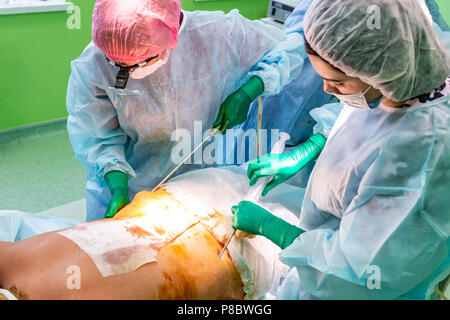 Chirurgie de liposuccion cosmétiques dans la salle d'opération, groupe de chirurgiens travaillant avec canule Banque D'Images