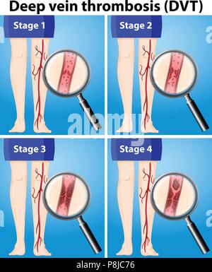 Quatre étapes de la thrombose profonde de veine illustration Illustration de Vecteur