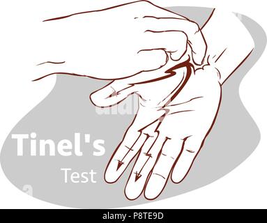 Vector illustration d'un test de Tinel Illustration de Vecteur
