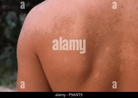 Le coup de soleil sur la peau du dos. L'exfoliation, la peau se détache. Sun tan dangereuses. Banque D'Images