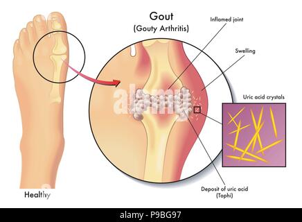 Vector illustration médicale des symptômes de la goutte Illustration de Vecteur