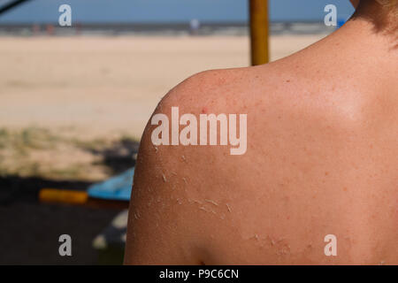 Le coup de soleil sur la peau du dos. L'exfoliation, la peau se détache. Sun tan dangereuses. Banque D'Images