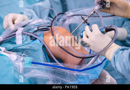 Munich, Allemagne. 19 juillet, 2018. Un médecin opérant sur un genou du patient dans le service de chirurgie orthopédique de l'OCM (Munich). Le patient a été équipé avec un ligament croisé de remplacement - qui a été préparé par l'un des tendons du patient lui-même - au cours de la chirurgie (arthroscopie). Crédit : Sven Hoppe/dpa/Alamy Live News Banque D'Images