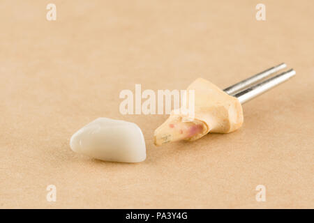 Acteurs et structures dentaires cermet pour la restauration de dents Banque D'Images