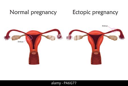 Et l'extra-utérine grossesse normale, de l'illustration. Dans une grossesse extra-utérine, l'embryon implants dans les trompes de Fallope, et non dans l'utérus. Banque D'Images
