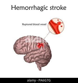 L'AVC hémorragique. Illustration d'une rupture d'un vaisseau sanguin dans le cerveau provoquant une course. Banque D'Images