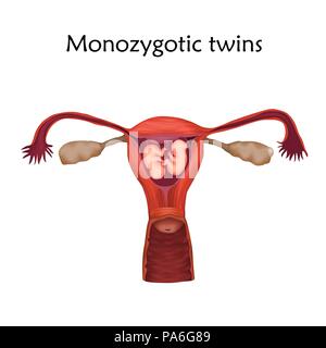 Grossesse multiple, illustration. Les jumeaux Monozygotic dans l'utérus partagent le même placenta. Banque D'Images