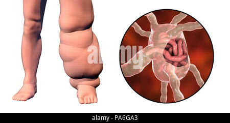 L'éléphantiasis. Illustration d'ordinateur de la jambe d'une personne touchée par l'éléphantiasis, également connu sous le nom de la filariose lymphatique. Cette maladie est causée par les vers nématodes parasites transmis en forme larvaire par la piqûre de moustiques. Les larves se développent en vers adultes (macrofilariae) que lodge en bloc et le système lymphatique, qui est également montré dans l'image. Ceci provoque la lymphe à s'accumuler dans les membres, une forme de lymphoedème. L'éléphantiasis est rarement mortel, mais provoque beaucoup de souffrances dans les régions tropicales. Le traitement implique la pharmacothérapie et d'hygiène rigoureuses pour prévenir les infections de la peau. Banque D'Images