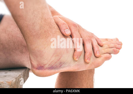 L'entorse de la cheville avec des ecchymoses isolé sur fond blanc Banque D'Images