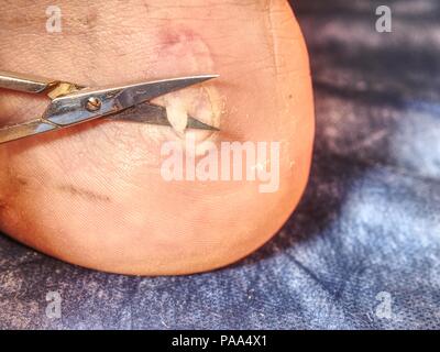 Abrasion avec blister sanglante. Blessure profonde sur la peau. Les Ciseaux coupent la peau morte sur le talon du patient. Banque D'Images