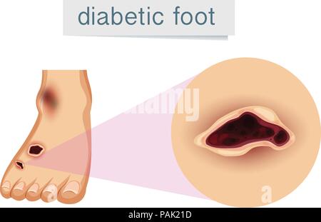 Un pied humain et d'une illustration Illustration de Vecteur
