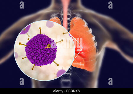 Les adénovirus infectent les poumons, l'illustration de l'ordinateur. Les adénovirus sont des virus à ADN qui infectent le plus fréquemment les voies respiratoires supérieures, des yeux et de l'intestin. Ils peuvent parfois causer une infection des voies respiratoires inférieures (pneumonie), en particulier chez les enfants et les patients immunodéprimés. Banque D'Images