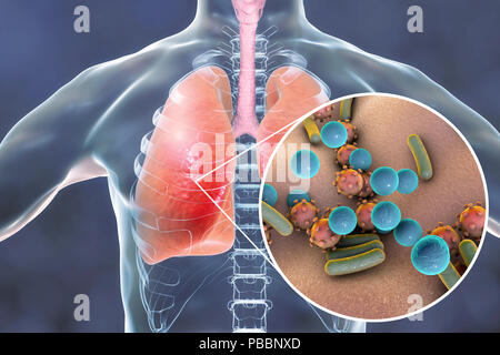 La pneumonie d'étiologie mixte, illustration conceptuelle. Les poumons et la vue rapprochée de bactéries et virus, deux des agents responsables de la pneumonie. Banque D'Images