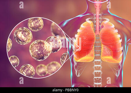 La blastomycose pulmonaires, illustration conceptuelle. Blastomyces dermatitidis champignon est l'agent causal de la maladie de la blastomycose, qui dispose d'un éventail de présentations. Elle affecte principalement les poumons et peut causer une maladie semblable à la grippe, une maladie aiguë semblable à la pneumonie, une maladie chronique semblable à la tuberculose ou l'potentiellement fatals, le syndrome de détresse respiratoire aiguë. Dans certains cas, il peut s'étendre à la peau, des os ou des organes, causant des lésions. Le traitement est avec des médicaments antifongiques. Banque D'Images