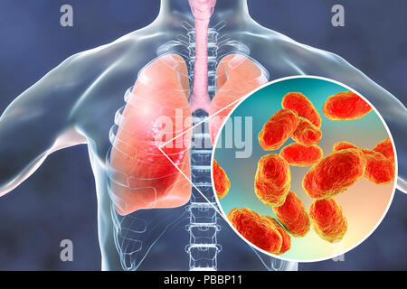 La pneumonie causée par la bactérie Haemophilus influenzae, illustration de l'ordinateur. H. influenzae sont coccobacillus les bactéries Gram-négatives. Ces bactéries provoquent un certain nombre de maladies, y compris la méningite chez les enfants, la pneumonie, l'épiglottite, laryngite, la conjonctivite, l'infection néonatale, l'otite moyenne (infection de l'oreille moyenne) et la sinusite chez l'adulte. H. influenzae sans danger colonisent les voies respiratoires supérieures à la plupart des humains au cours des premiers mois de la vie. La propagation des souches encapsulés à l'origine de maladies telles que la bronchite et la pneumonie. Banque D'Images