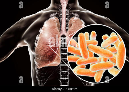 La maladie du légionnaire, ordinateur conceptuel illustration. La legionella pneumophila bactéries sont la cause de la maladie du légionnaire. Ces bacilles (forme de tige) sont des bactéries Gram négatif. L. pneumophila a été identifié comme un agent pathogène après une mystérieuse épidémie de pneumonie causé 29 décès à un congrès de la Légion américaine en 1976. Cette bactérie a été trouvé vivant dans des réservoirs d'eau, des douches et des systèmes de climatisation. La maladie provoque des lésions pulmonaires pulmonaire fatale chez les personnes âgées et impropre. Banque D'Images
