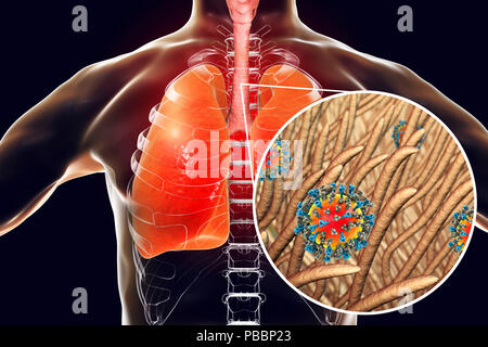 La pneumonie causée par les virus de la rougeole, l'illustration de l'ordinateur conceptuel. Virus de la rougeole, de la groupe de virus Morbillivirus, se compose d'un ARN (acide ribonucléique) noyau entouré par une enveloppe garnie de protéines de surface hémagglutinine et neuraminidase-protéine de fusion, qui sont utilisés pour fixer et à pénétrer dans une cellule hôte. La rougeole est une maladie très infectieuse éruption prurigineuse avec de la fièvre. Elle affecte principalement les enfants, mais une attaque donne généralement l'immunité à vie. La pneumonie est l'une des complications de la rougeole. Banque D'Images