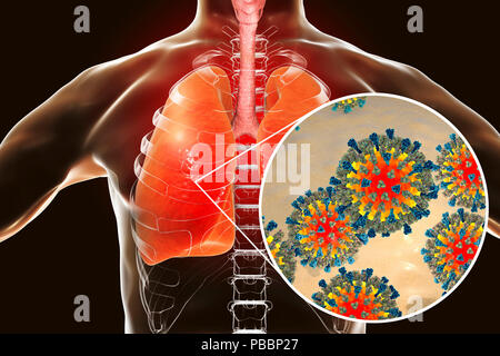 La pneumonie causée par les virus de la rougeole, l'illustration de l'ordinateur conceptuel. Virus de la rougeole, de la groupe de virus Morbillivirus, se compose d'un ARN (acide ribonucléique) noyau entouré par une enveloppe garnie de protéines de surface hémagglutinine et neuraminidase-protéine de fusion, qui sont utilisés pour fixer et à pénétrer dans une cellule hôte. La rougeole est une maladie très infectieuse éruption prurigineuse avec de la fièvre. Elle affecte principalement les enfants, mais une attaque donne généralement l'immunité à vie. La pneumonie est l'une des complications de la rougeole. Banque D'Images