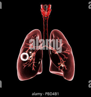 Tuberculose pulmonaire caverneux-fibreux. Illustration d'ordinateur montrant cavern (cavité) dans le poumon droit avec une couche fibreuse dans son mur. Banque D'Images