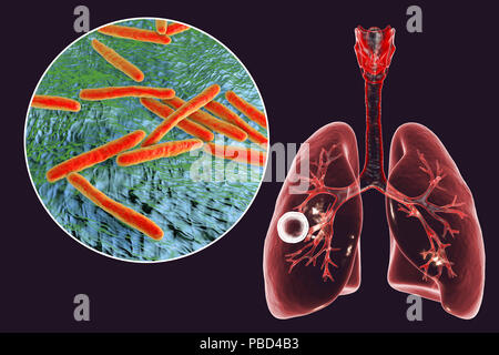 Tuberculose pulmonaire caverneux-fibreuse et vue rapprochée de la bactérie Mycobacterium tuberculosis, l'agent étiologique de la tuberculose. Illustration d'ordinateur montrant cavern (cavité) dans le poumon droit avec une couche fibreuse dans son mur. Banque D'Images