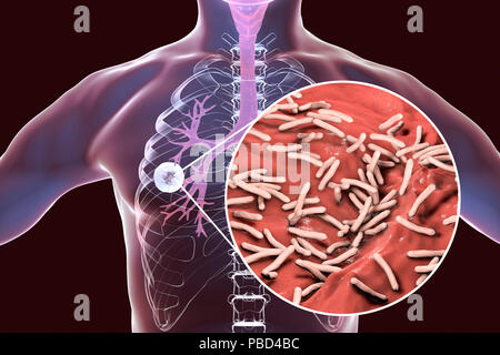 Tuberculose pulmonaire caverneux-fibreuse et vue rapprochée de la bactérie Mycobacterium tuberculosis, l'agent étiologique de la tuberculose. Illustration d'ordinateur montrant cavern (cavité) dans le poumon droit avec une couche fibreuse dans son mur. Banque D'Images