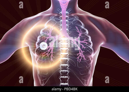 Traitement et prévention de la tuberculose pulmonaire, l'illustration de l'ordinateur conceptuel. Caverne en surbrillance (cavité) dans le poumon droit avec une couche fibreuse dans son mur. Banque D'Images