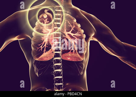 Traitement et prévention de la tuberculose, l'illustration conceptuelle. Banque D'Images