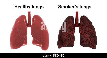 Les poumons du fumeur et en bonne santé, illustration de l'ordinateur. Banque D'Images
