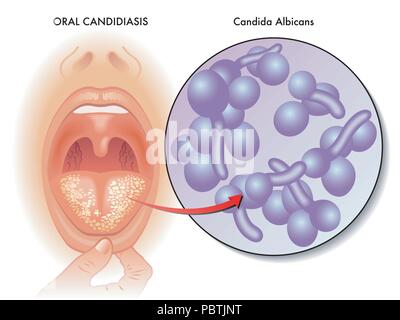 Un vecteur illustration médicale d'une infection de la langue appelée candidose orale. Illustration de Vecteur