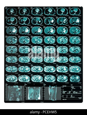 Irm. M. Entérographie de l'intestin grêle d'un test médical non invasive utilisée pour diagnostiquer les maladies de l'intestin, comme la maladie de Crohn Banque D'Images