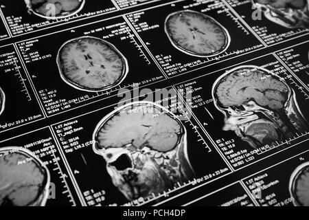 Analyse par résonance magnétique du cerveau. L'IRM scanner de la tête. Banque D'Images