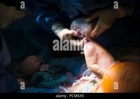 Une femme donnant naissance à des jumeaux par césarienne (Heverlee, 30/12/2016) Banque D'Images