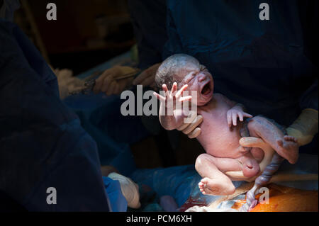 Une femme donnant naissance à des jumeaux par césarienne (Heverlee, 30/12/2016) Banque D'Images