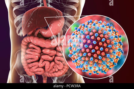 L'infection par l'hépatite C. Illustration de l'ordinateur et du foie vue rapprochée de l'hépatite C les virus. Banque D'Images