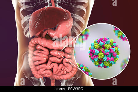 L'infection à norovirus, illustration de l'ordinateur. Le norovirus est un genre d'ARN (acide ribonucléique) virus (de la famille des Caliciviridae), qui sont responsables d'environ la moitié de tous les cas de gastro-entérite dans le monde entier. La maladie se caractérise par des nausées, vomissements, diarrhée et douleurs abdominales. La diarrhée résulte en une perte de liquide et de la déshydratation, qui peut entraîner la mort chez les jeunes, les personnes âgées et les personnes immunodéprimées si elle n'est pas traitée rapidement. Banque D'Images