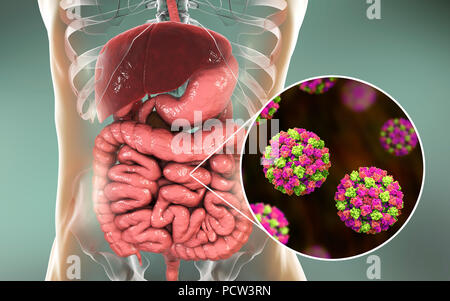 L'infection à norovirus, illustration de l'ordinateur. Le norovirus est un genre d'ARN (acide ribonucléique) virus (de la famille des Caliciviridae), qui sont responsables d'environ la moitié de tous les cas de gastro-entérite dans le monde entier. La maladie se caractérise par des nausées, vomissements, diarrhée et douleurs abdominales. La diarrhée résulte en une perte de liquide et de la déshydratation, qui peut entraîner la mort chez les jeunes, les personnes âgées et les personnes immunodéprimées si elle n'est pas traitée rapidement. Banque D'Images