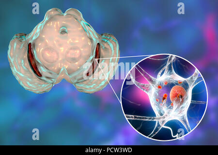 La substantia nigra. Illustration de l'ordinateur un dégénéré substantia nigra dans la maladie de Parkinson. La substantia nigra joue un rôle important dans la récompense, la toxicomanie, et de mouvement. La dégénérescence de cette structure est caractéristique de la maladie de Parkinson. Dans la maladie de Parkinson, les neurones de la substantia nigra contiennent des corps de Lewy, qui sont des dépôts de protéines, montré ici sous forme de petites inclusions sphériques rouges dans le cytoplasme du neurone. Banque D'Images