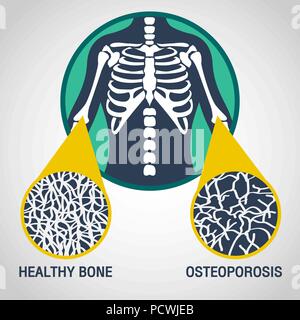 L'ostéoporose l'icône logo vector illustration Illustration de Vecteur