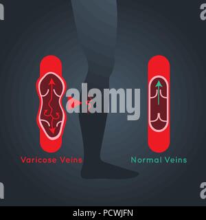 Varices icône logo vector illustration Illustration de Vecteur