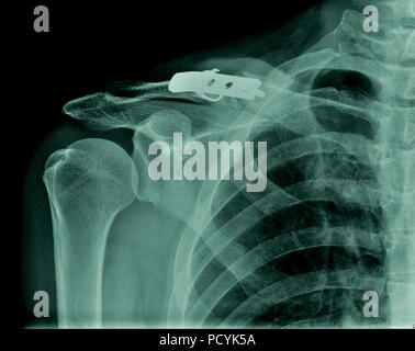 X-ray avec fracture de la clavicule la fixation après l'opération Banque D'Images