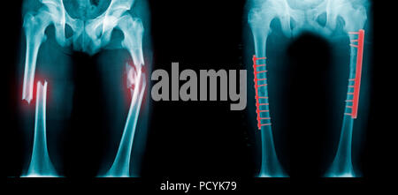 Fracture de jambe avec fixation post op Banque D'Images