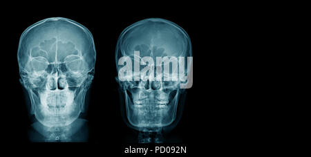 Radiographie du crâne Banque D'Images