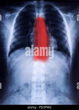 X-Ray Film de colonne vertébrale humaine La scoliose pour le diagnostic médical Banque D'Images