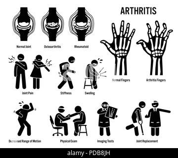 L'arthrite, des douleurs articulaires, et d'icônes. Pictogrammes montrent des signes d'arthrite, les symptômes, le diagnostic et le traitement. Illustration de Vecteur