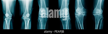 Genou arthrose collection x-ray image Banque D'Images